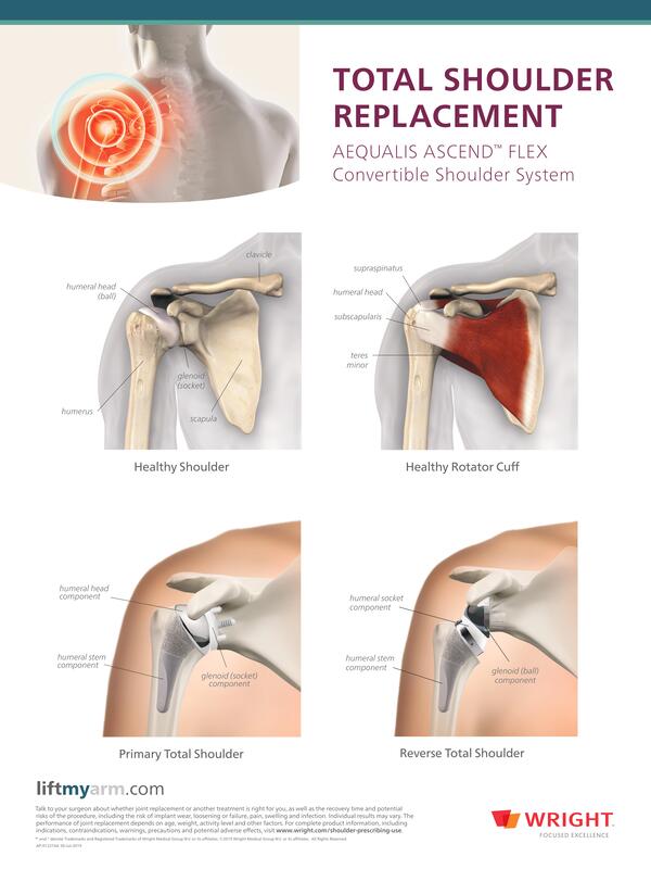 reverse shoulder replacement